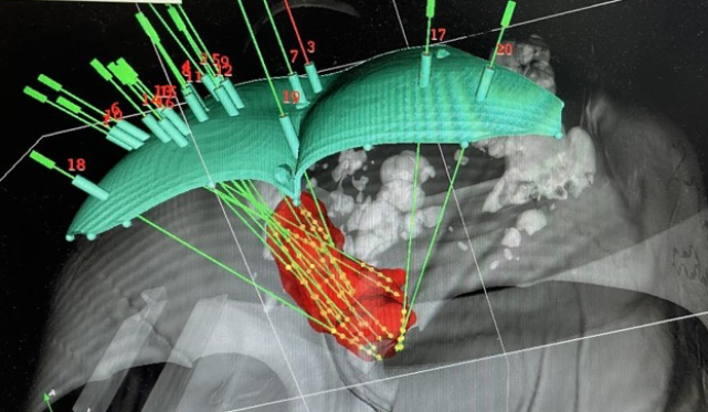 我们都没放弃,你更不能:北医三肿瘤放疗科主任王俊杰和他的粒子放疗