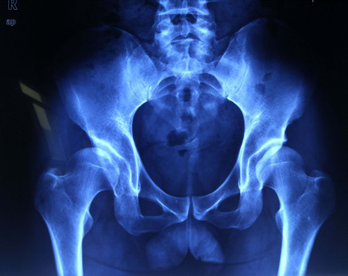 潍坊市人民医院:截骨?保髋!不疼了!