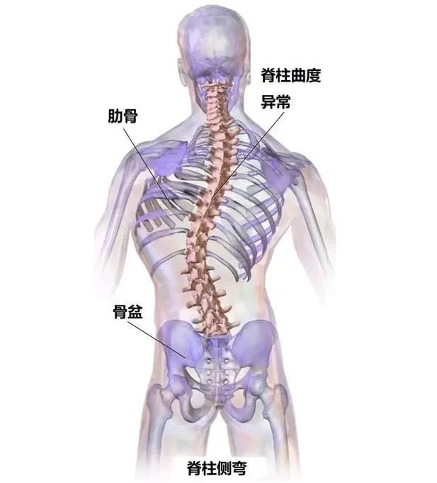 正骨科普肩膀一高一低妙龄女患上脊柱侧弯