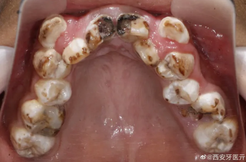 这种情况被称为"可乐牙",即常喝碳酸饮料导致牙齿患上了"酸蚀症".