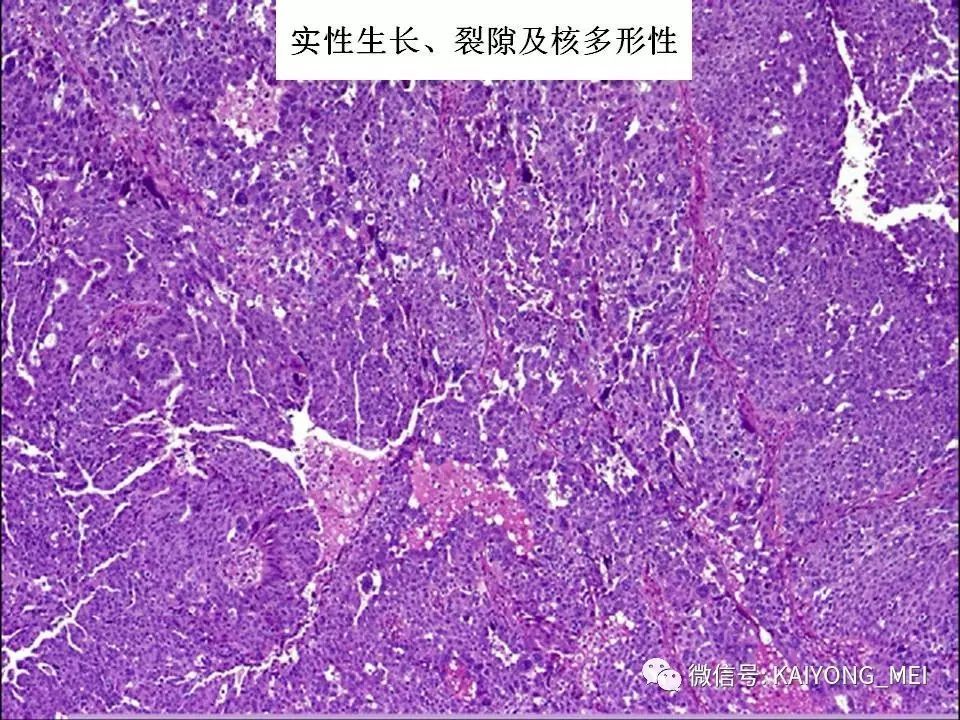 卵巢癌的病理診斷新進展(一)