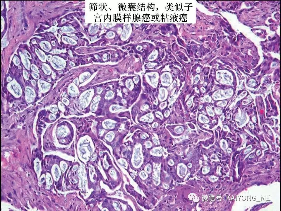 卵巢癌的病理诊断新进展(一)