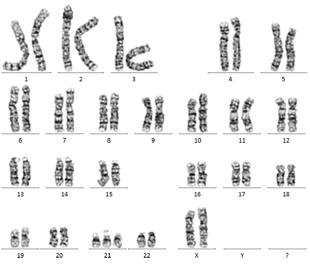 天使科普什么是唐氏综合征什么原因导致了唐氏综合征