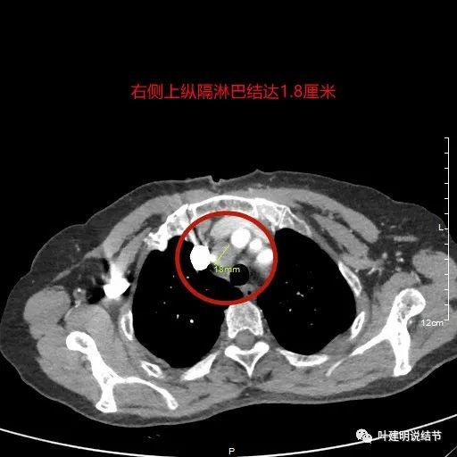 小肺癌也會轉移!_騰訊新聞