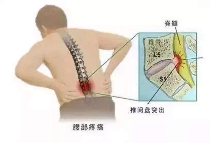 腰間盤突出,竟成當代大學生通病?