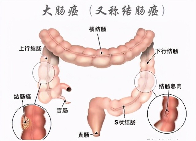 如何预防大肠癌 做好四件事不给它 可乘之机 全网搜