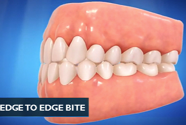 这种看起来已经很齐了的牙齿,你觉得还有必要矫正吗?