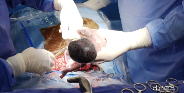 (哈利玛·西塞产下九胞胎)不过,此前,25岁产妇哈利玛