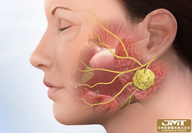 jmt日本醫療耳朵前部的腮腺瘤也會癌症化