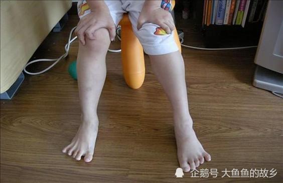 更严重的患儿可能出现呼吸肌和心肌无力