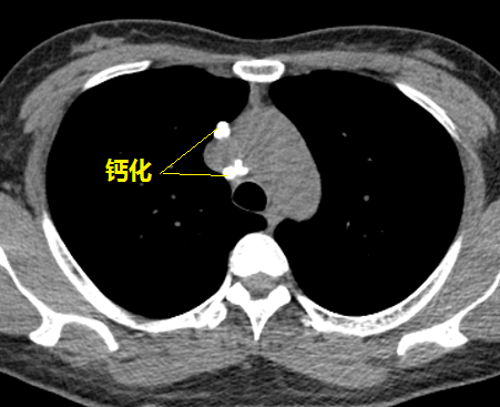 咳嗽一年找不到原因原来是肺部钙化惹的祸
