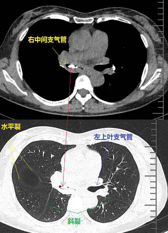 图16 胸部ct另外,这个患者的钙化灶非常危险,因为钙化灶的一端距离肺