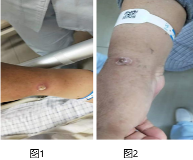 又一例留置针外渗感染这种特点的患者要特别注意
