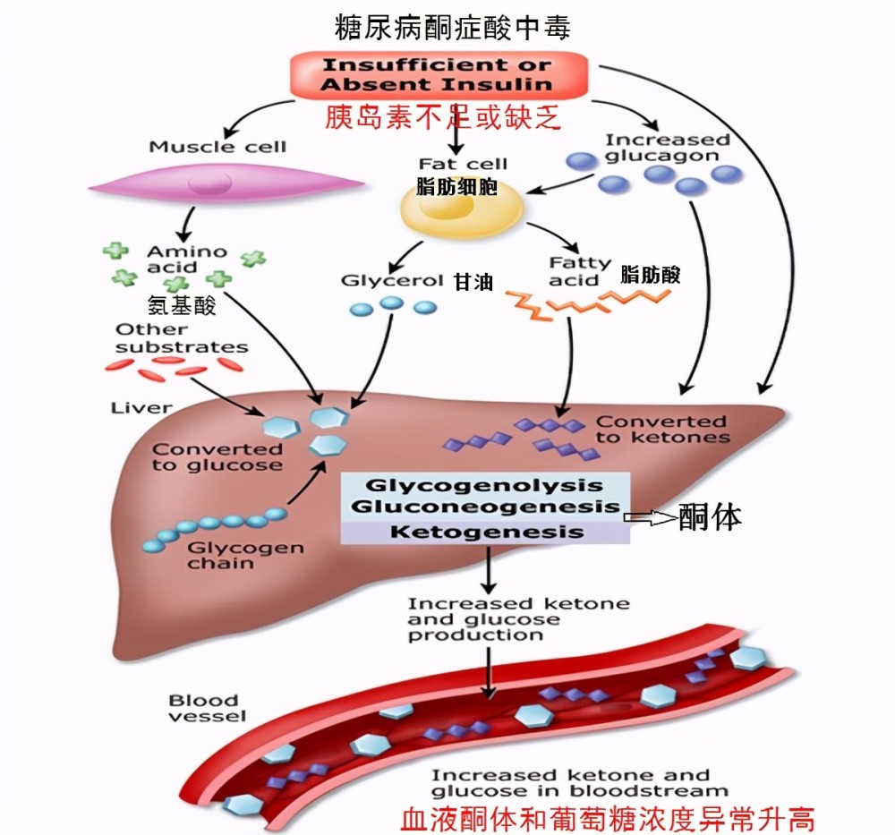 糖尿病酮症酸中毒是如何发生的?