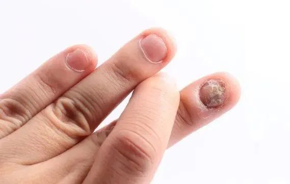 手指有这3个症状可能有血栓请及时检查