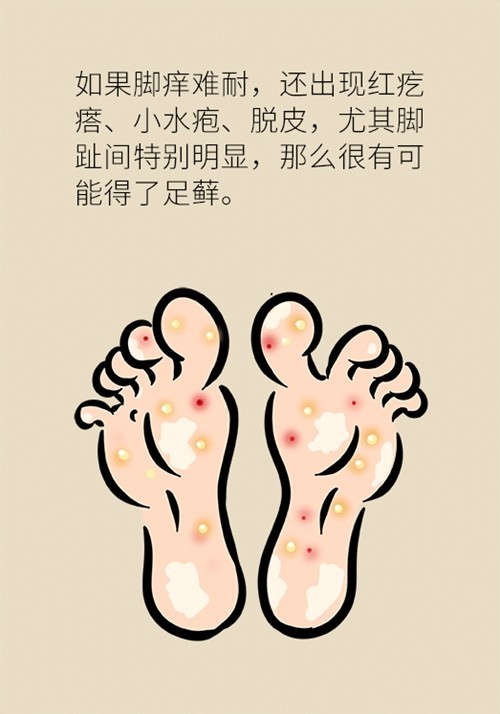 治脚气需知道这7招