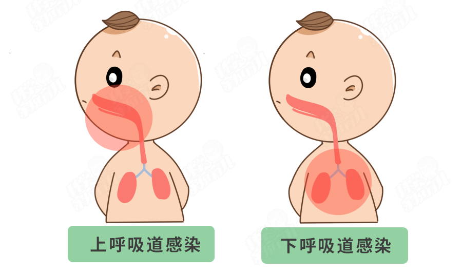 肺炎是下呼吸道感染(感染集中在肺,支气管部位)● 感冒是上呼吸道