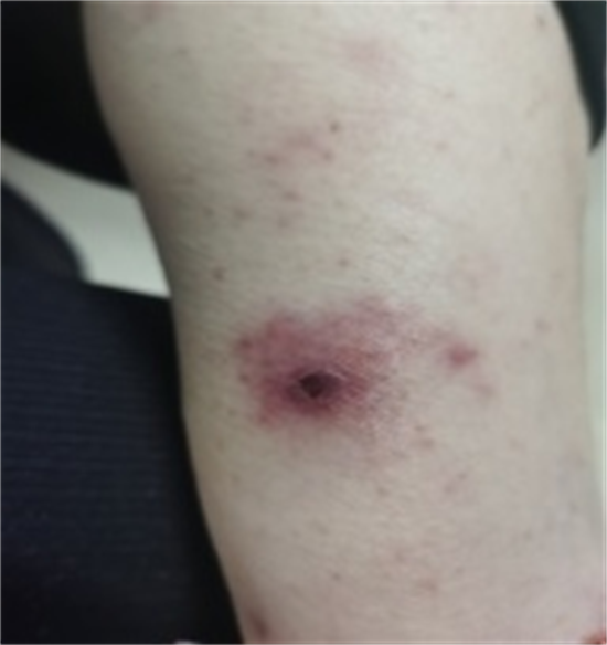 又到夏天恙虫病高发期62岁大妈被咬后险丧命