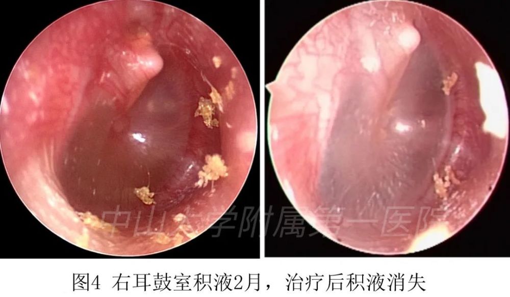 就診於中山一院耳科門診,鼻內鏡檢查雙側鼻道未見膿涕,腺樣體腫大,耳