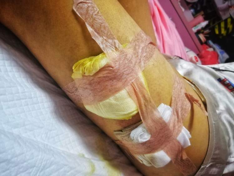 老叶较真背部创口溃烂得缝不了针桦玫医美还给女子施行双腿吸脂手术