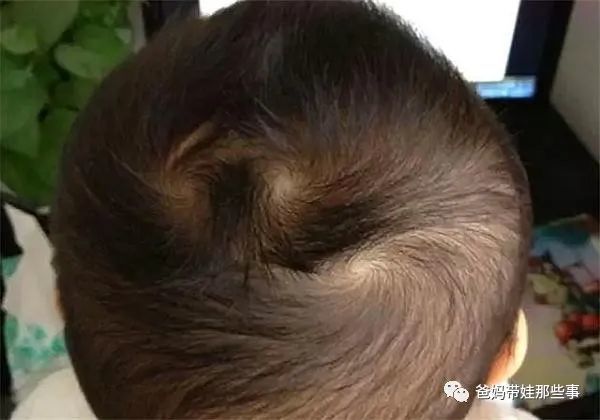 孩子头顶长两个旋代表什么和性格有关吗