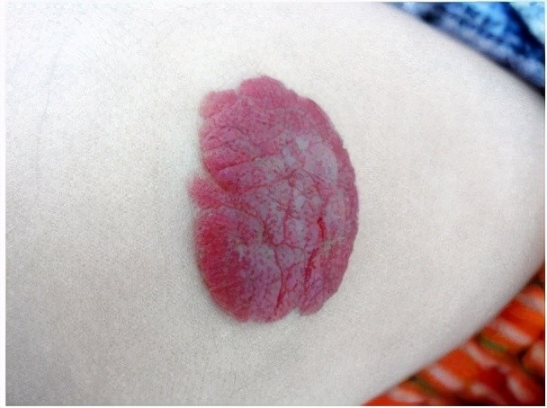 草莓状血管瘤一般不会自行消退,只有少部分患者会自行消退,大多在2岁