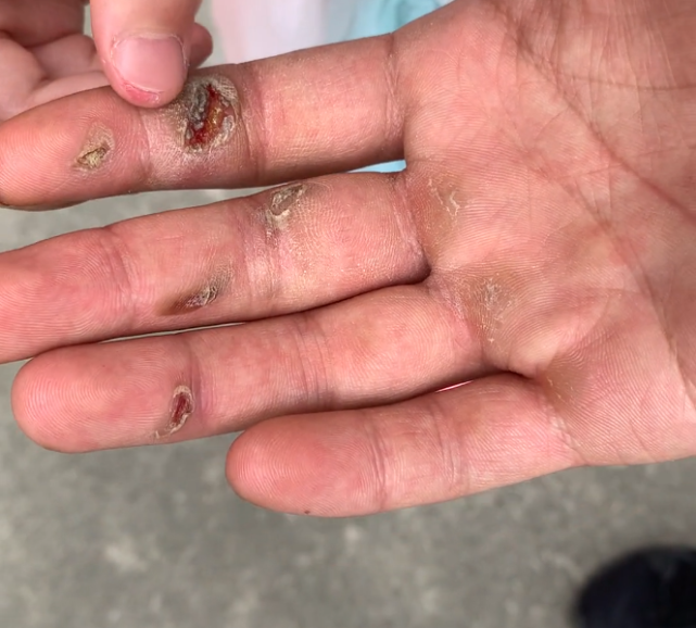 本能驱使下,就对着他伤口处吹了个"爱的呼呼"