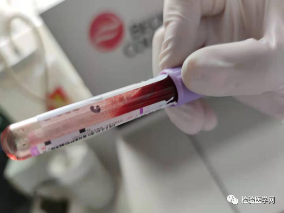 面对一份 高冷 的红细胞凝集标本 你会如何处理 腾讯新闻