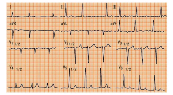 這6種常見心電圖你一定要學會