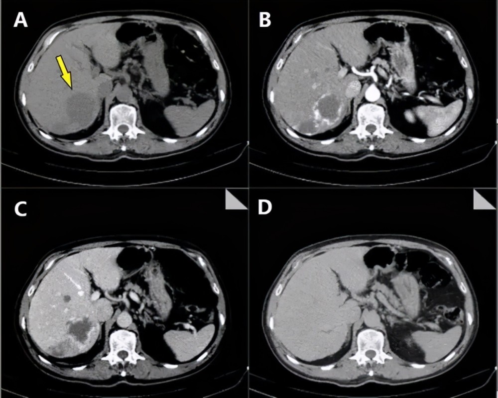 而造成肝损害最常见的肝病包括:病毒性肝病,药物性肝损伤,脂肪肝,非