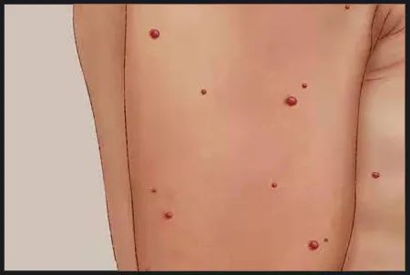 常见症状其实这些"红斑"就是老年性血管瘤,又叫樱桃状血管瘤,俗称血管