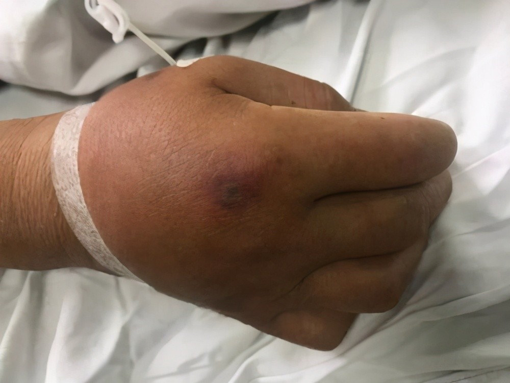 高速公路一司机昏迷造成交通事故,医生:被蜂蛰的!什么蜂这么毒