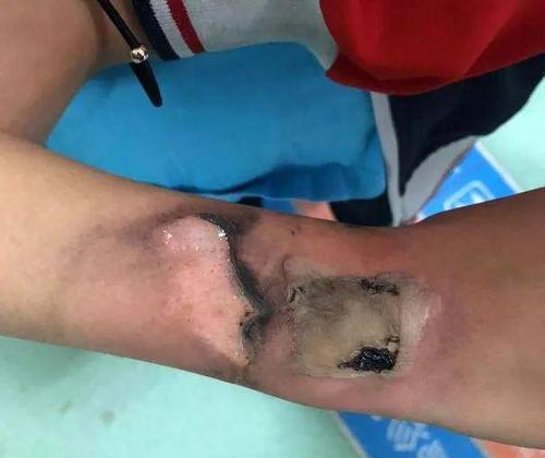电话手表突然爆炸4岁女童三度烧伤需要植皮