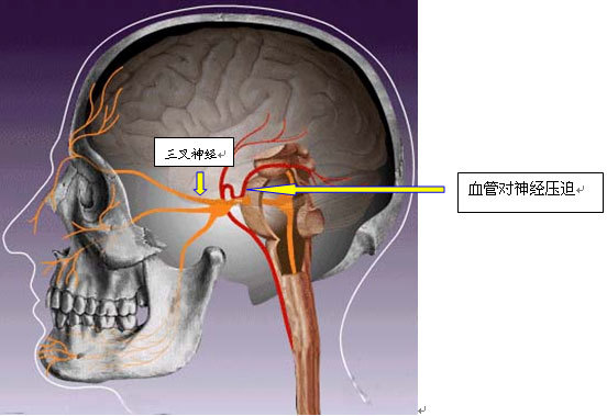 三叉神經痛是一種僅發生在面部三叉神經分佈區內反覆發作的陣發性劇烈