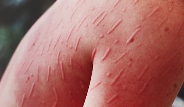 三种最奇葩的过敏反应对所有的食物都过敏岂不是要饿死