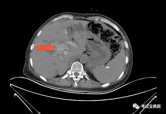 案例分析-急性梗阻性化脓性胆管炎