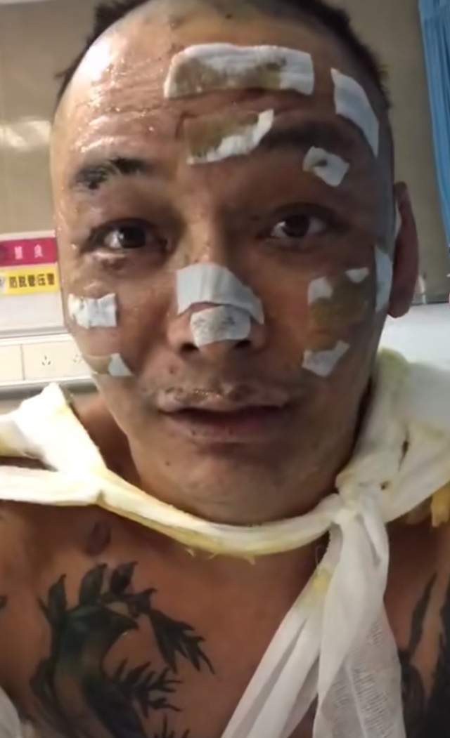 奇葩说辩手徐真真因不慎使用香薰引发火灾面部被二级严重烧伤疤痕触目