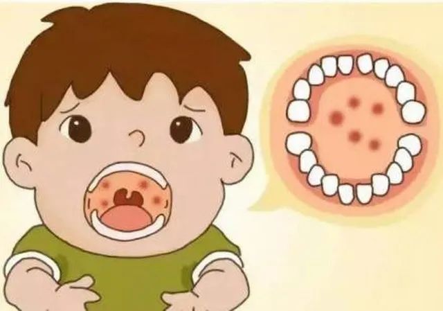 健康驿站 警惕 疱疹性咽颊炎来了 腾讯新闻