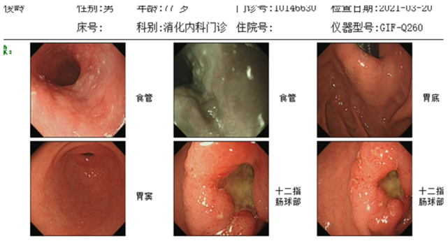 1,食管低級別上皮內瘤變;2,紅斑滲出性胃炎;3,十二指腸球部潰瘍(a1期)