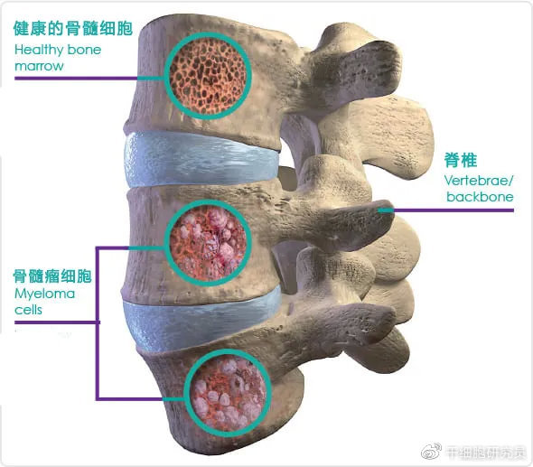 无癌生存5年,car-t疗法帮助多发性骨髓瘤患者恢复健康