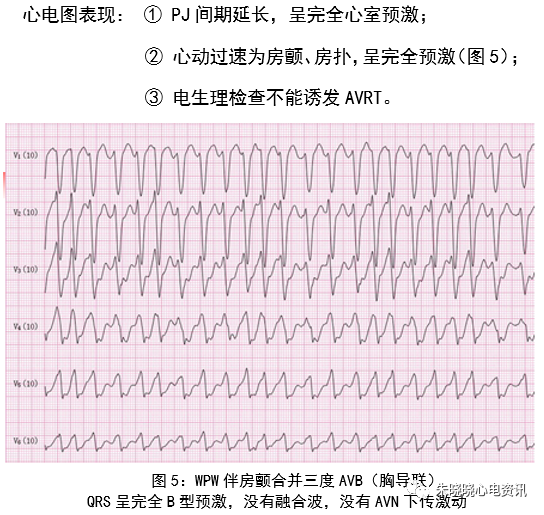 預激綜合徵心電圖少見表現與診斷思路