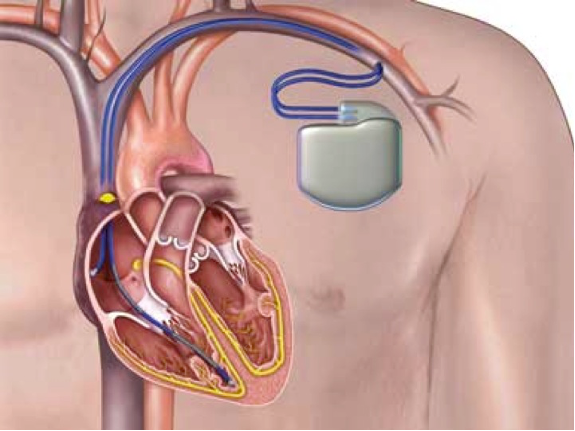 植入式心律转复除颤器示意图