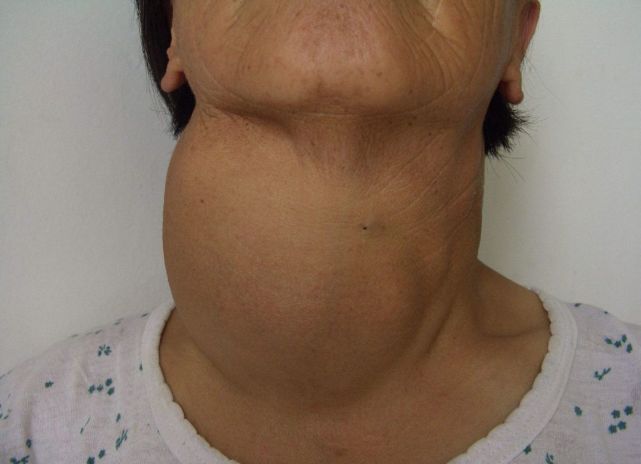 女性容易患甲状腺结节这3种食物要少吃对健康有好处