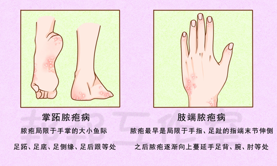 一种叫掌跖脓疱病,指的是脓疱局限于手掌的大小鱼际,足跖,足底,足侧缘