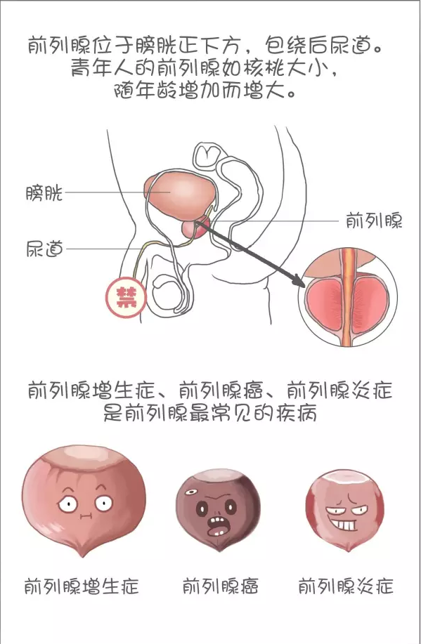 前列腺钙化患者治了三年没效果想放弃,还好他妻子的坚持