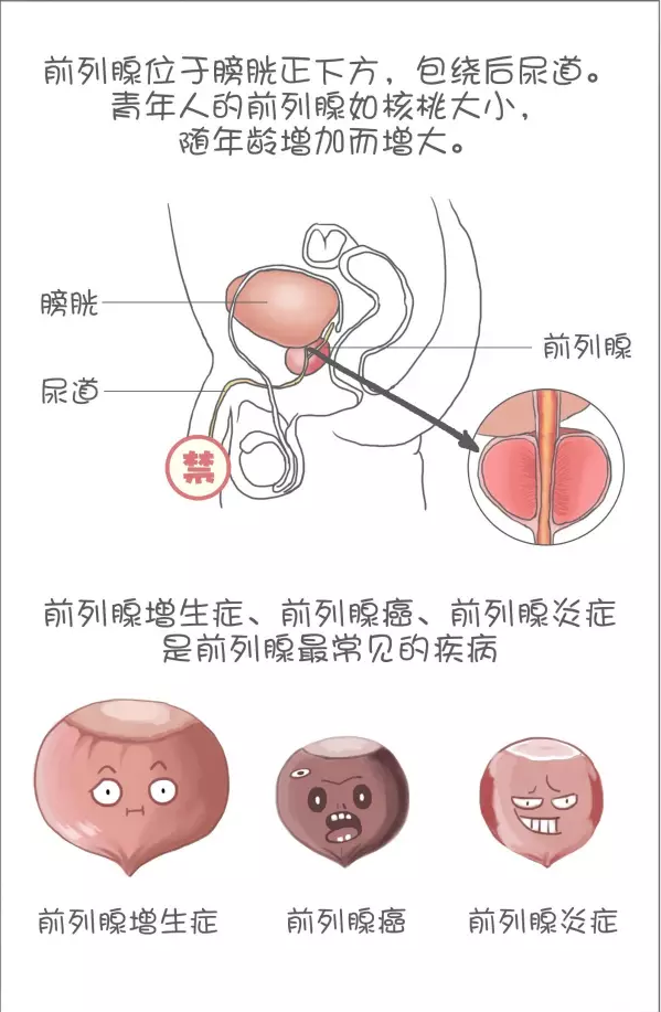 前列腺鈣化患者治了三年沒效果想放棄,還好他妻子的堅持