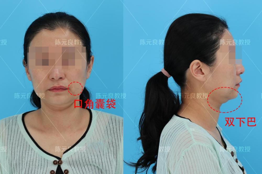 在这里科普一下,口角囊袋也叫"羊腮,表现为木偶纹外下方的局部隆起