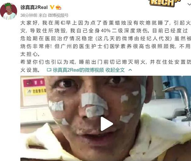 睡觉忘吹蜡烛导致歌手徐真真全身二级深度烧伤同时惨遭毁容