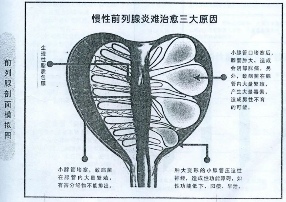 前列腺中叶图片