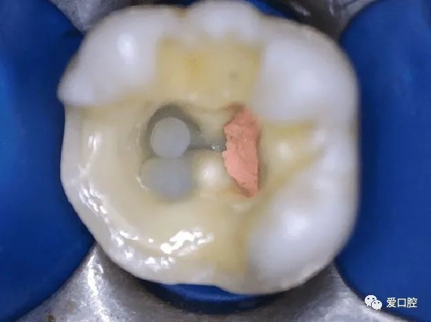 总结,急性牙髓炎和根尖周炎都要开放引流,开髓口大小只要保证能让髓腔